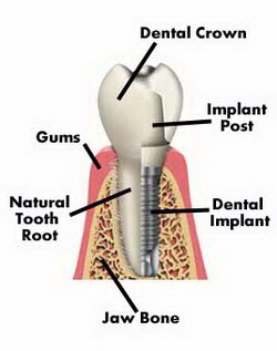 Cheap Teeth Implants