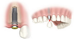 Dental Teeth Implants