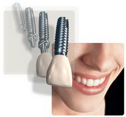 Implants Teeth