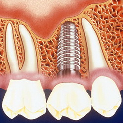 Mini Teeth Implants