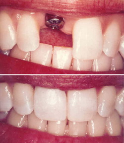 Permanent Teeth Implants