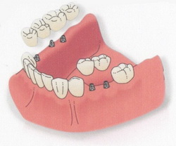 Teeth Implants Prices