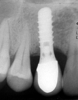 Teeth Implants Pros and Cons