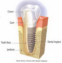 Teeth Implants