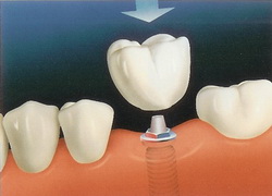 Titanium Implants Teeth